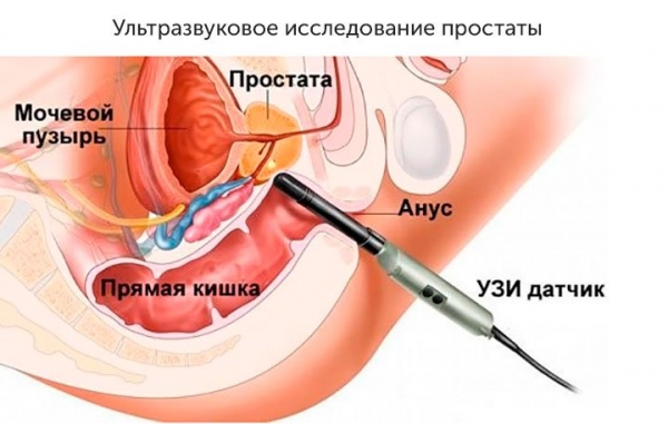 Боли в заднем проходе при простатите